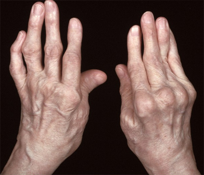 Лечение артрита руки